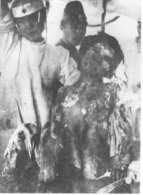 A burned victim of the atomic bomb at Hiroshima 